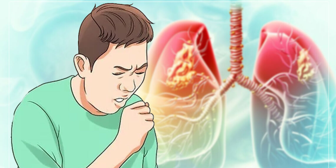 इटहरीमा क्षयरोगबाट वार्षिक ३५ जनाको मृत्यु , बिरामीहरू अस्पताल जानै मान्दैनन्